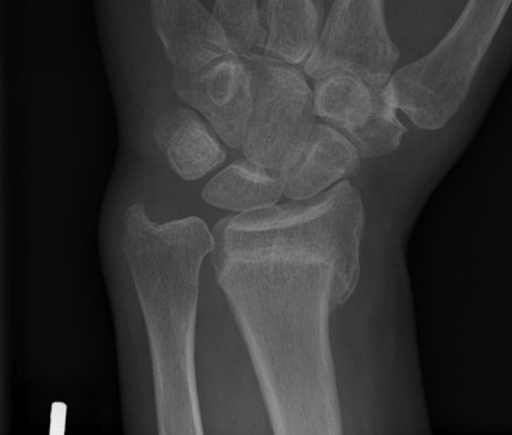 Distal Radial Malunion AP